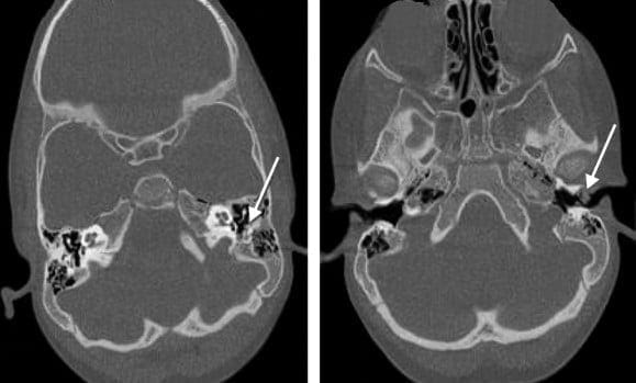 rabdomiosarcoma-embrionario.jpg