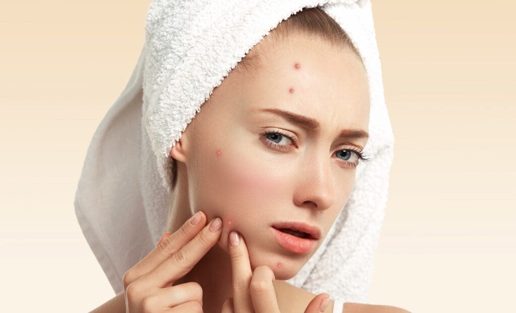 huevo contra el acne